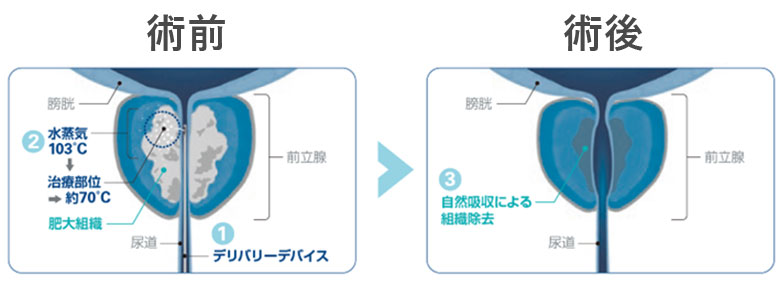 WAVE療法で用いる機器